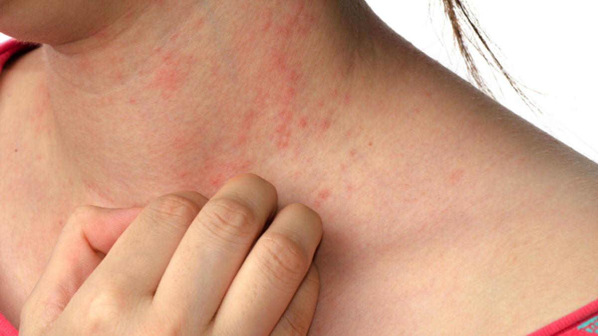 Uyuz İlaçlama firması